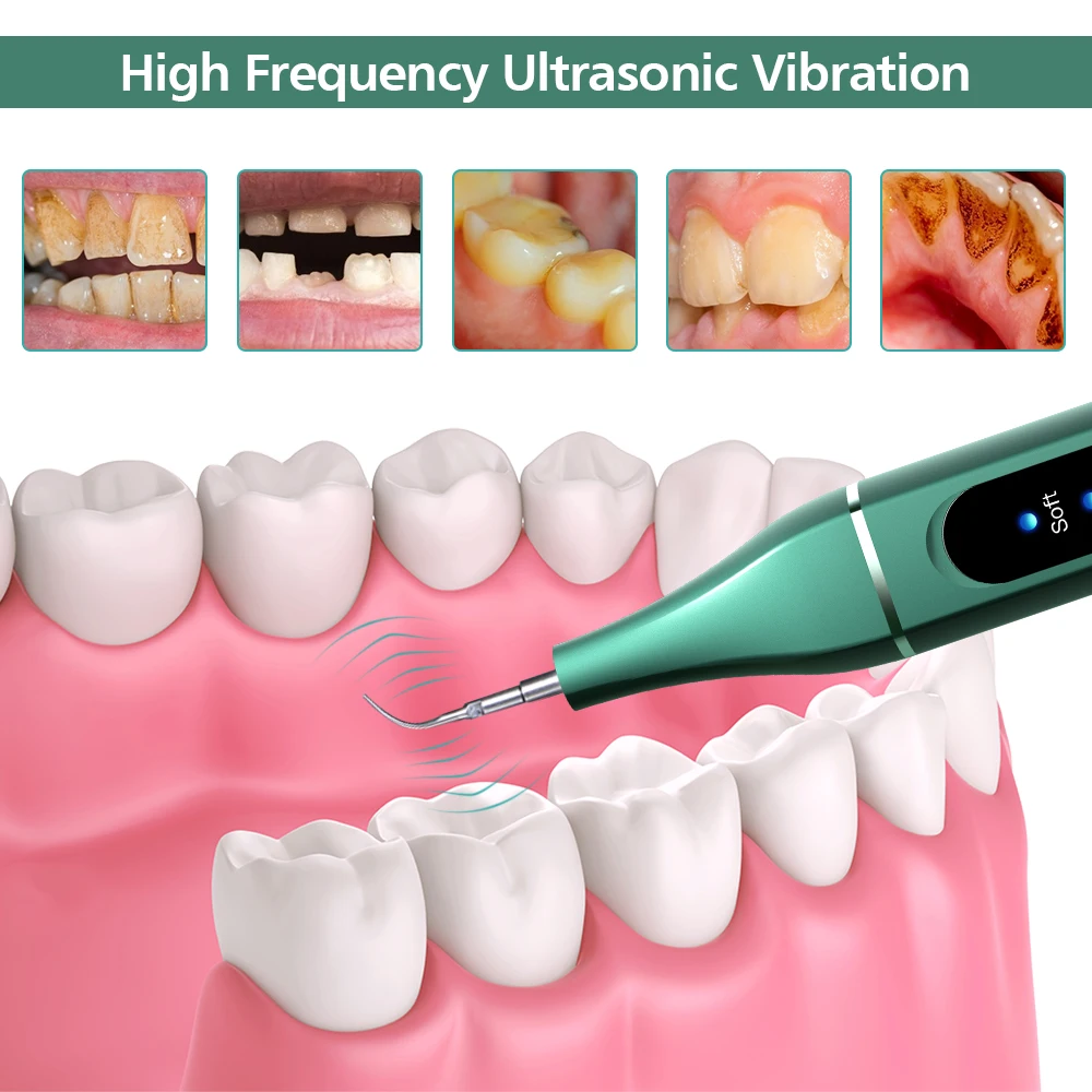 Electric Wireless Cu Ultrasunete Detartraj Dentar Albire Dinti Calcul Tartru Remover Instrumente Curat Dinte Pata Îngrijire Orală Imagine 3